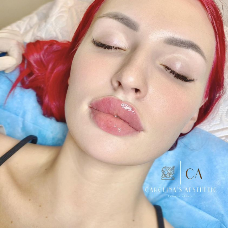 Carolina's Aesthetic - Thẩm Mỹ Filler Nha Trang